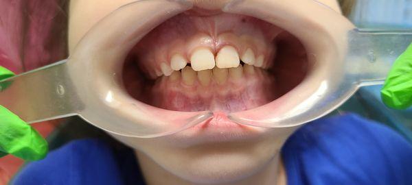 Another great example of the difference Dr. Heidi Zuckerman can make in your child's smile!