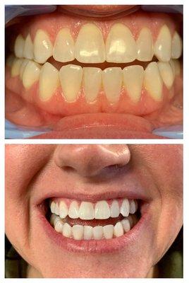 Organic Teeth Whitening: brighten your smile 6-16 shades in just ONE appointment with little to no sensitivity.