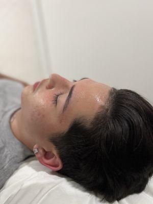 Acne facial