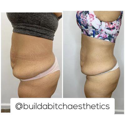 Two sessions of body contouring !