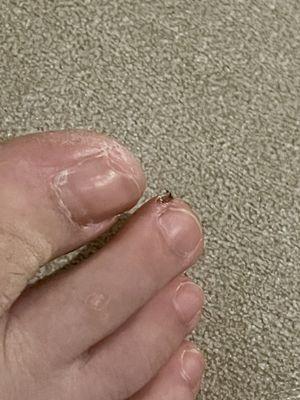 Dry skin he drilled over, uneven toenail on big toe as it wasn't drilled over and the drill size was too big/unsanitized. Used carelessly.