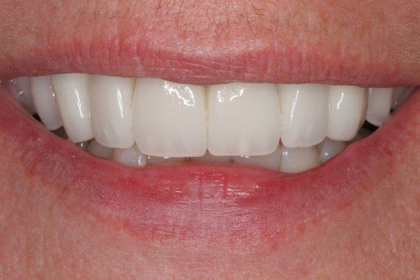 Gorgeous result for a lovely lady! JR waited over 20 years for this smile and makes the most of it!