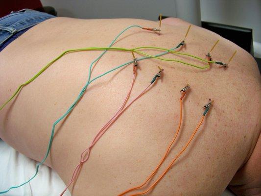 Trigger point Dry needling to the thoracic paraspinals