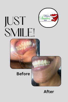 Whiter Smiles RVA Teeth Whitening & Oral Wellness Spa