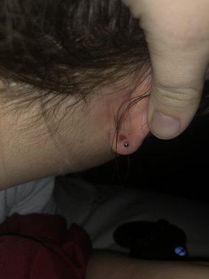 ear clamp bruise