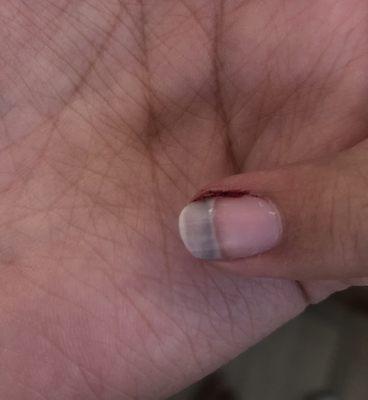 Bloody cut on finger