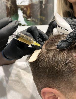 PRP - Your own blood drawn and spun into "liquid gold/plasma" containing highly concentrated growth factors that's injected into your scalp.