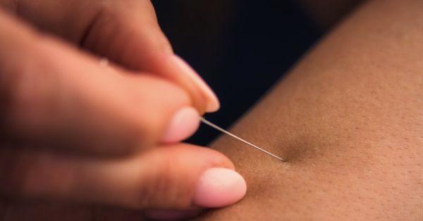 Acupuncture Treatments 
Call Today to Schedule (516) 783-1454