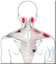 Tight knots in muscle fibers called trigger points can cause local and referral pain patterns (i.e. headaches, tingling/numbness in limbs)