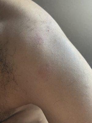 Bedbug bites