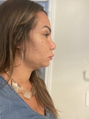 After yes...really. After 3 "Kybella" treatments