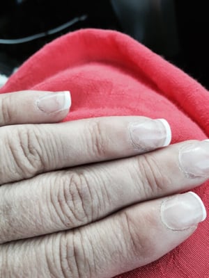 Nails bubbling and peeling. Cuticles are in horrible condition.