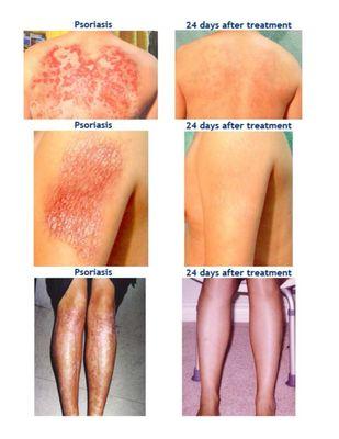 Comparison of skin diseases before and after treatment