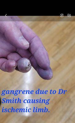 Gangrene Due to Dr Andrew Smiths NEGLIGENCE causing Ischemic Limb.