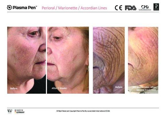 Plasma Pen Facelift and Wrinkle Reduction