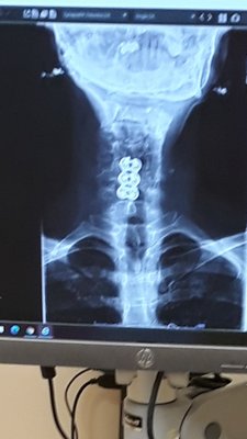 My x-rays from right after surgery and recent