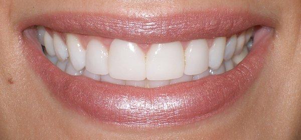 Porcelain Veneers by Dr Stern