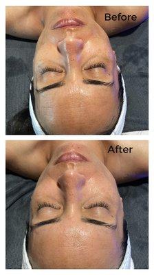 Before and after from one facial treatment