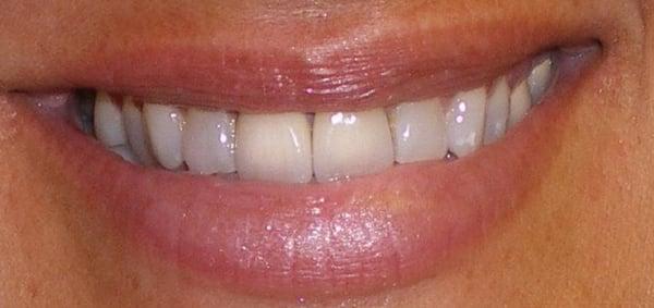 Porcelain Crowns