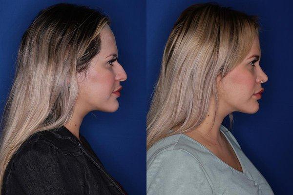 31 year old female six weeks following her cosmetic rhinoplasty