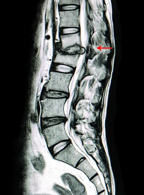 Spinal Decompression: Promotes the movement of water, oxygen, and nutrient-rich fluids into the disks so they can heal.