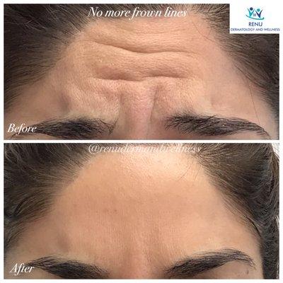 Soften frown lines with quick and easy Botox! Patient is frowning in both photos!