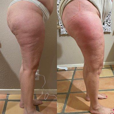 Cellulite treatment