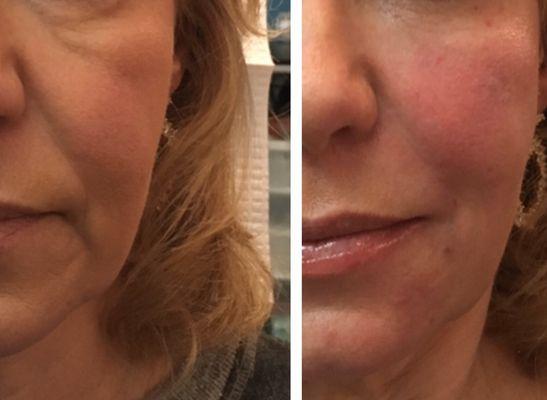 Liquid face rejuvenation- under eye, cheek, marionette lines, nasal labial folds and WOW..