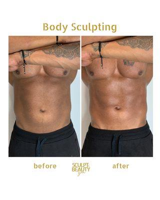 Body Sculpting (Abdomen Session)