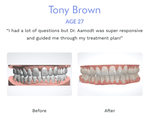 Corrected gaps between teeth in 7 months!