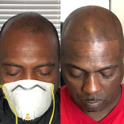 scalp micropigmentation hairline tattoo