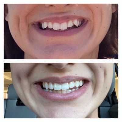 Invisalign results! Beautiful straight teeth.