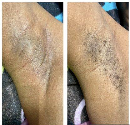 Underarm Sugaring