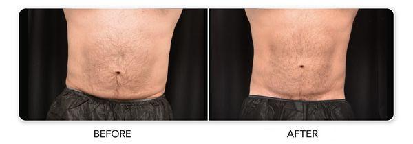 Before and after CoolSculpting® results on a male abdomen