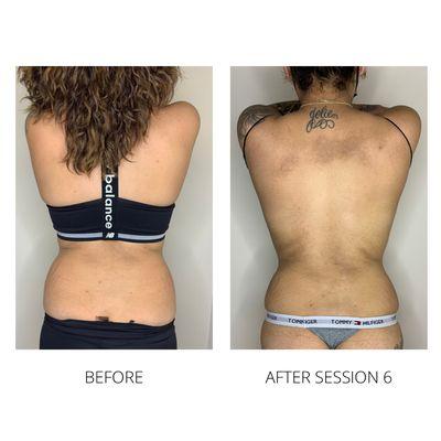 Body Sculpting results of the flanks after 6 treatments