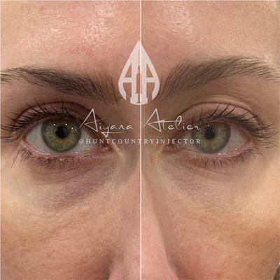 PRF to undereyes (1 treatment)