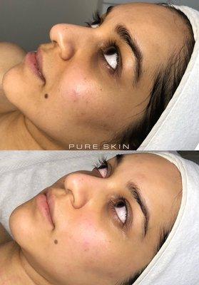 Before/After treatment. 1. Dark Circles 2. Pigmentation 3. Overall tone - BRIGHTENED!