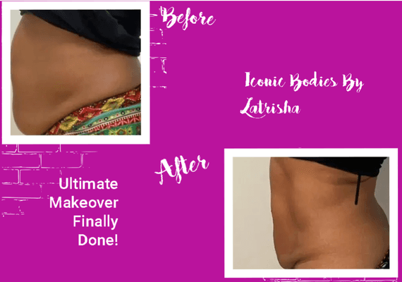 Results After 6 Sessions of Lipo Cavitation/Laser Lipo