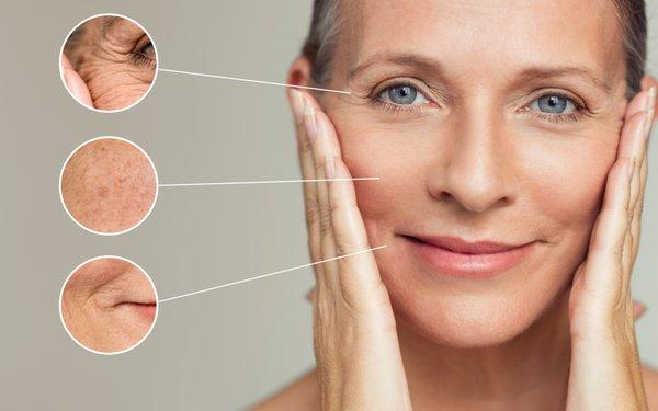 Benefits of medical-microneedling with HA are skin hydration, plumping, reducing pigmentation, and  skin lines or wrinkles