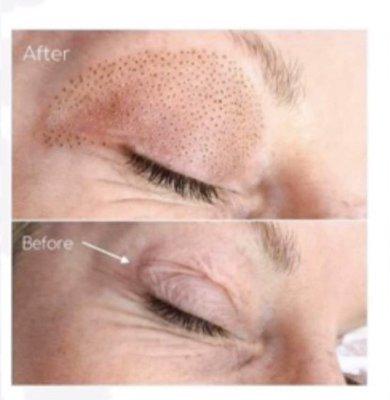 Plasma Fibroblast Skin Tightening on Eyelid