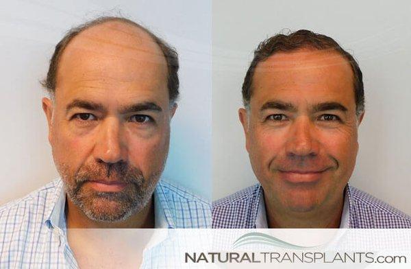 Best Hair Transplant