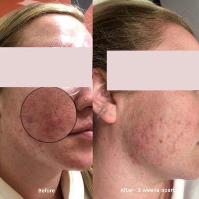 Acne Specialist- Root cause approach + customized at home skin care routine. Client shown- 3 weeks apart.