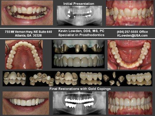 Full Mouth Rehabilitation with Gold Copings