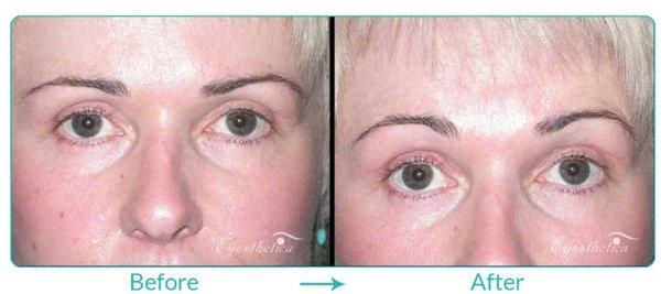 Before and After: Brow Lift by Dr. Steven C. Dresner