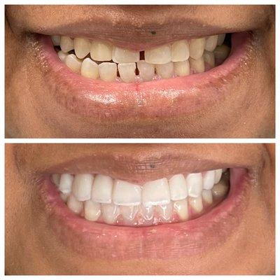 Smile Makeover