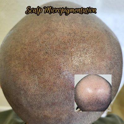 Non-surgical hair loss solution