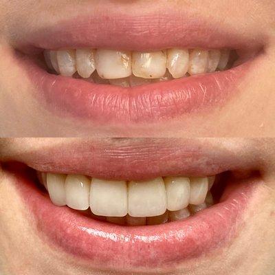 6 veneers