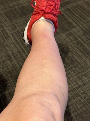 Formerly swollen ankle after several weeks of acupuncture.