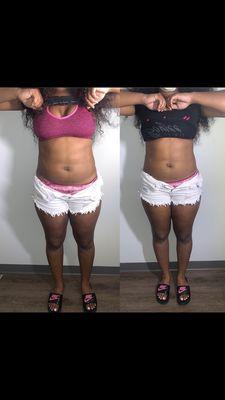 Lipo Cavitation