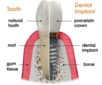 Dental Implant and Crown